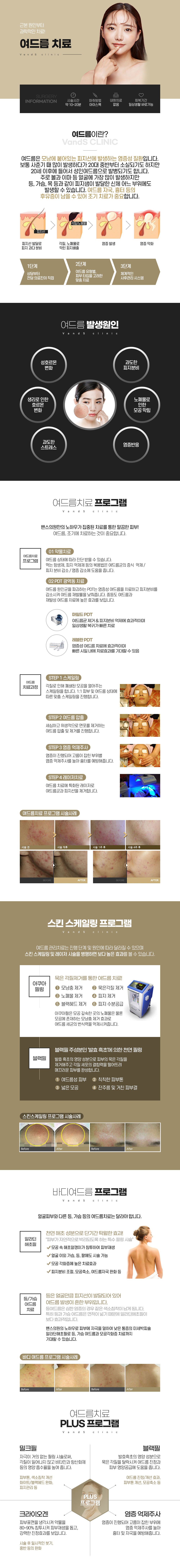 여드름치료 시술안내 이미지1