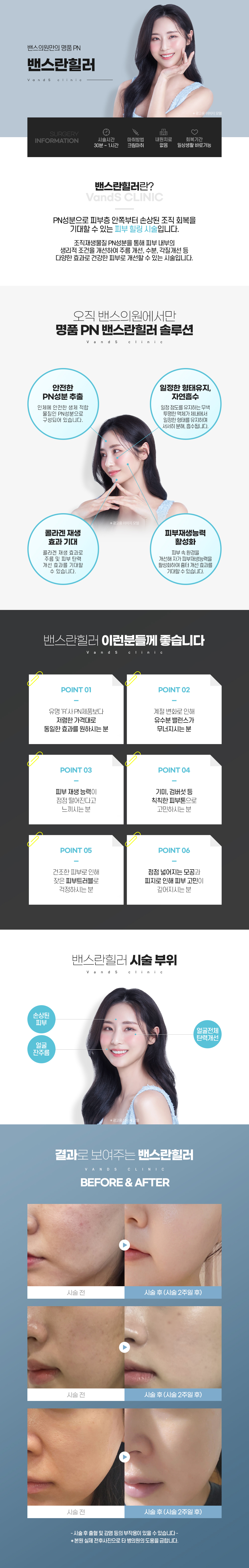 밴스란힐러 시술안내 이미지1