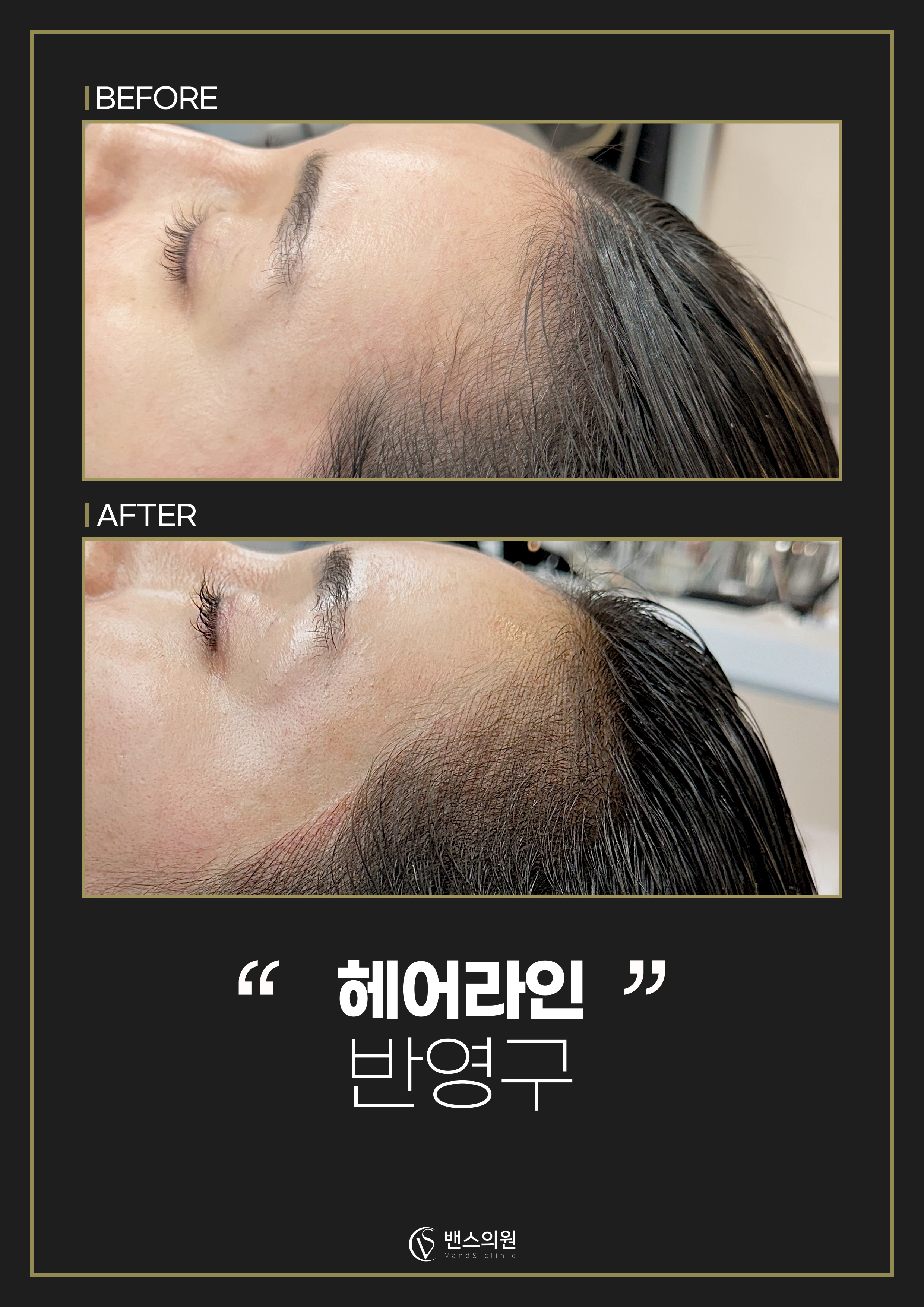 프리미엄 헤어라인 반영구 시술안내 이미지4