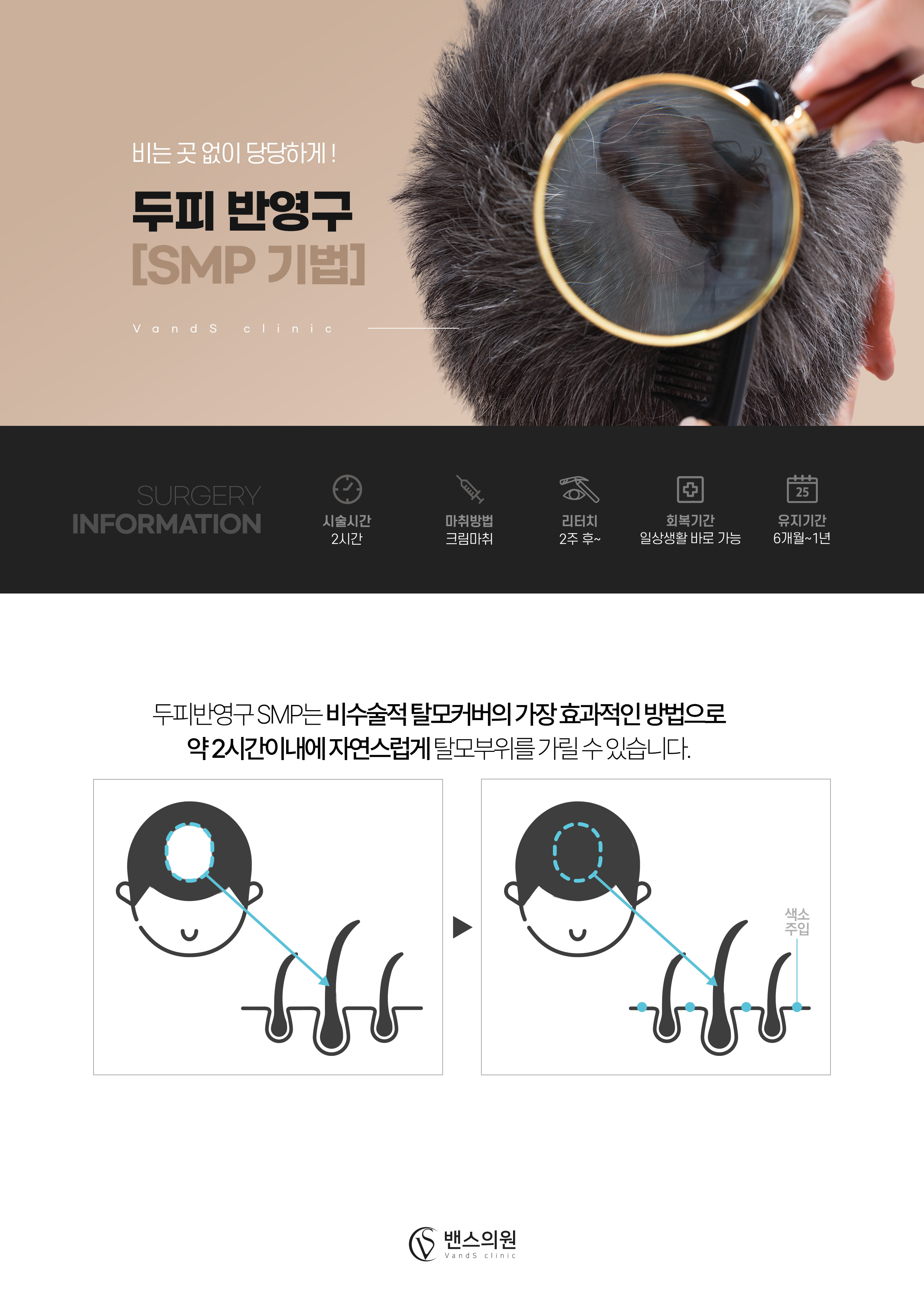 SMP두피 시술안내 이미지1