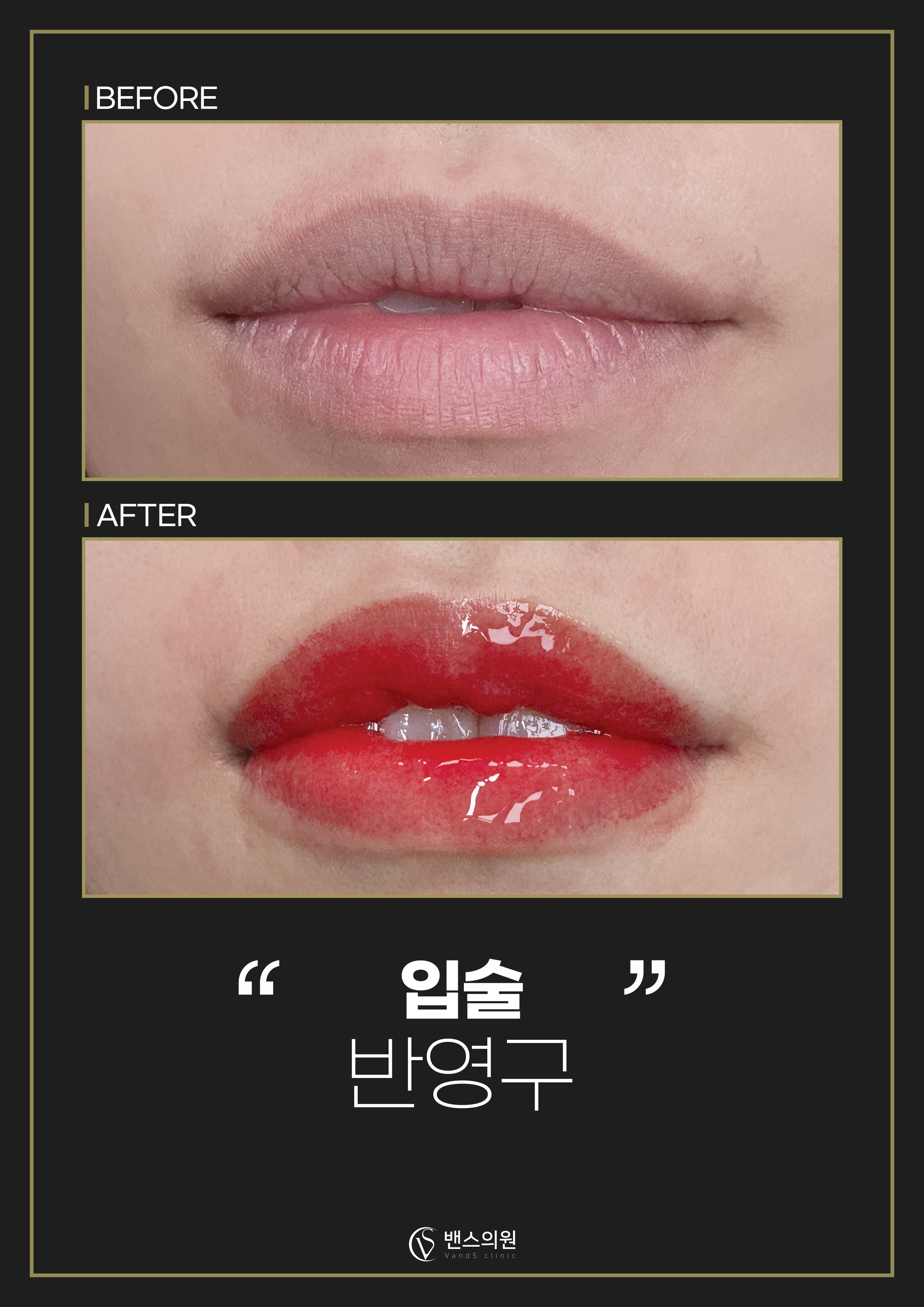 프리미엄메디컬 입술반영구 시술안내 이미지6